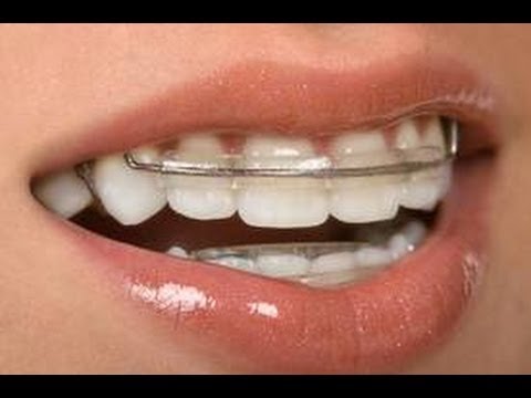 how to whiten retainers