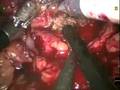 Robotic Partial Nephrectomy: The Tulane University Technique