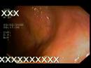 colonic worm