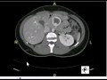 CT abdomen -Anatomy