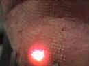 sciton-profractional-rejuvenation-with-coagulation.html