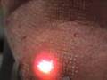 videos de Sciton Profractional Rejuvenation with Coagulation