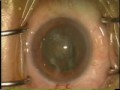 One hand technique cataract surgery 白内障手術耳側角膜一手法