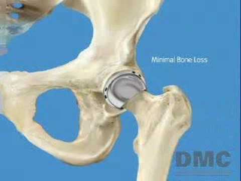 Birmingham Hip Resurfacing Procedure