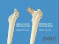 Birmingham Hip Resurfacing Procedure