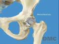 Birmingham Hip Resurfacing Procedure
