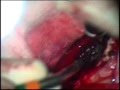 Glioblastoma Surgery, Tumeur du cerveau (Thrace-Greece)