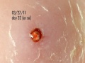 botfly larva in my ankle - days 32-34 update