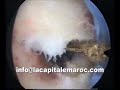 hysteroscopic treatment  of septate uterus