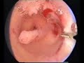 hysteroscopic treatment  of septate uterus