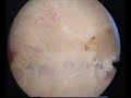 hysteroscopic treatment  of septate uterus
