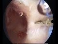 bipartite uterus