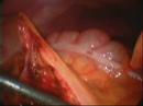 Control vascular en las colectomías laparoscópicas Colectomy