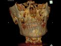 iCAT Flythrough Extreme Headache patient in Orthodontics with Subluxed C2 and Early TMJ