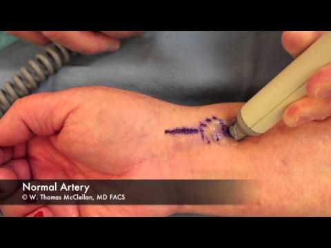 how to repair arteries