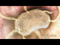 Fighting Infection by Clonal Selection Fighting Infection by Clonal Selection