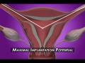 3D/4D Ultrasound-Guided Embryo Transfer