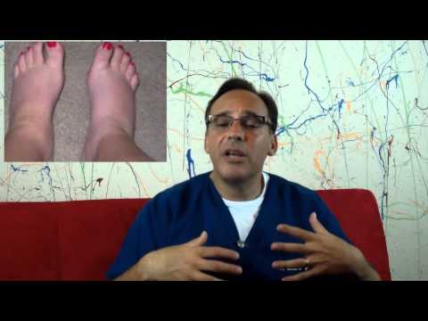 how to get rid of edema in feet