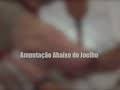 Enfaixamento para amputados abaixo do Joelho - Conforpes
