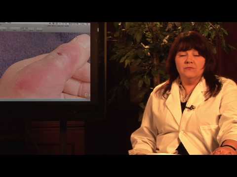 On the third day of a black widow spider bite, the area around the bite can On the third day of a black widow spider bite, the area around the bite can