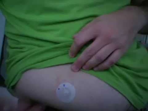 Tu Diabetes Video #8 - Insulin Pump, ...