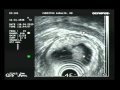Excision Of Polyp In Rectum Excision Of Polyp In Rectum