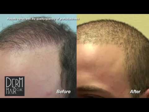 how to cover up hair transplant
