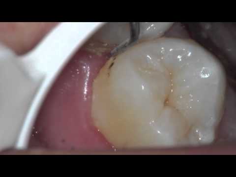 how to treat gingivitis