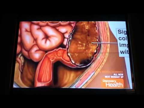 how to relieve impacted bowel