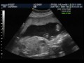 Baby Liam 3D/4D Ultrasound - 24 weeks (part 3)