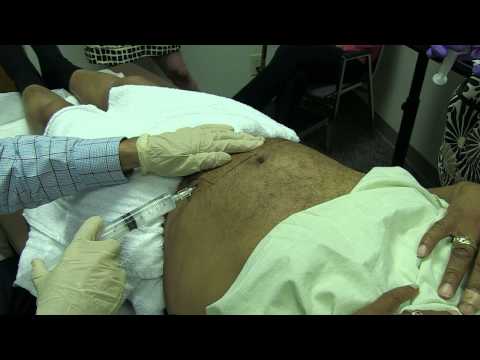 how to harvest stem cells