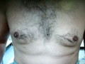 عمليات تجميل الصدر