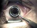 Daniel's LASEK at Park Avenue Laser Vision