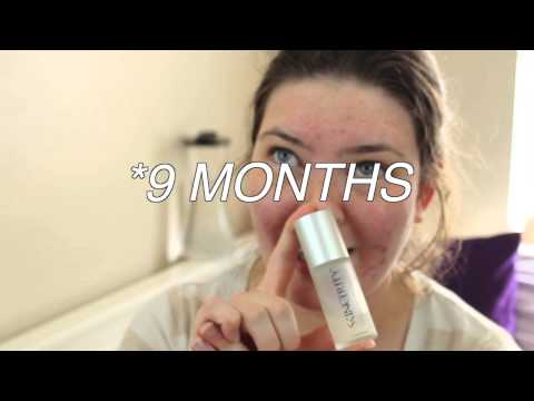 How I Use Skincerity + Acne and Pimples!!