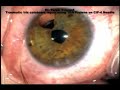 Traumatic Iris coloboma repair Siepser slip-kno10/0 Prolene