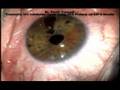 Traumatic Iris coloboma repair Siepser slip-kno10/0 Prolene