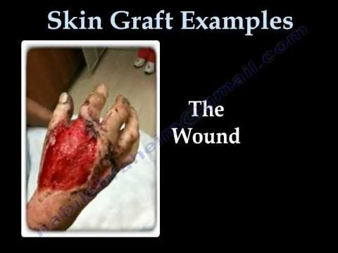 how to care for a skin graft