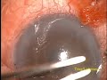 Trabeculectomy Revision Right eye