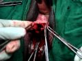 TVT.O for SUI ,Trans obturator sling,Bladder sling,TOT,by Abdul Wahab
