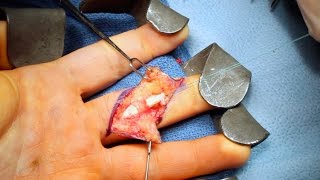 Live Surgery: Flexor Digitorum Profundus (FDP) Finger Tendon Repair