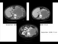 Neoadjuvant therapy