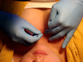 dermal anchor