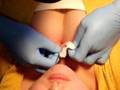 dermal anchor