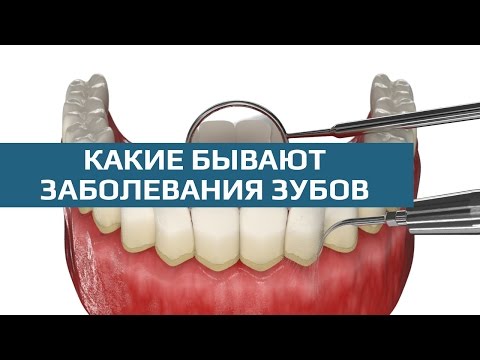 Виды заболеваний зубов