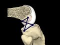 Superimposed four-bar linkage to follow joint flexion there are no fixed link lengths