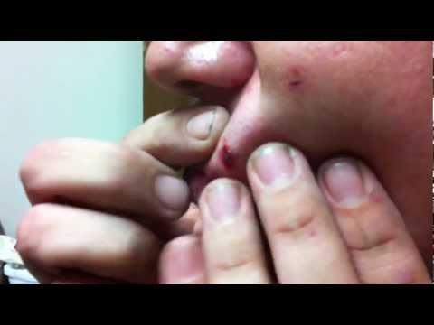how to remove a bb from under skin