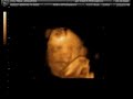 Baby Amber at 32 weeks 3D sonogram