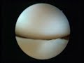 knee arthroscopy kneecap cartilage joint