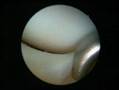 knee arthroscopy kneecap cartilage joint