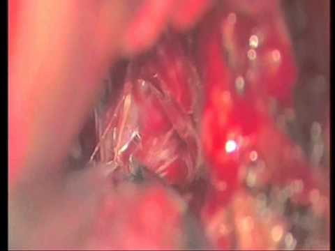 Lateral Supraorbital Access For TSM - Part 3